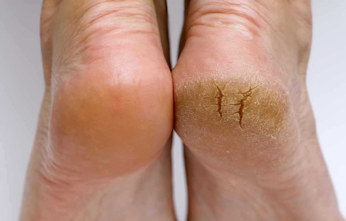 DIY Foot Peel For Cracked Heels The Detox Lady